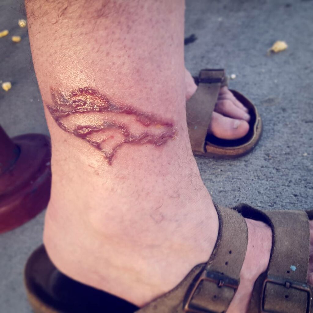 How To Stop Your New Tattoo Burning - 3 Simple Steps 12 Tattoo Burn