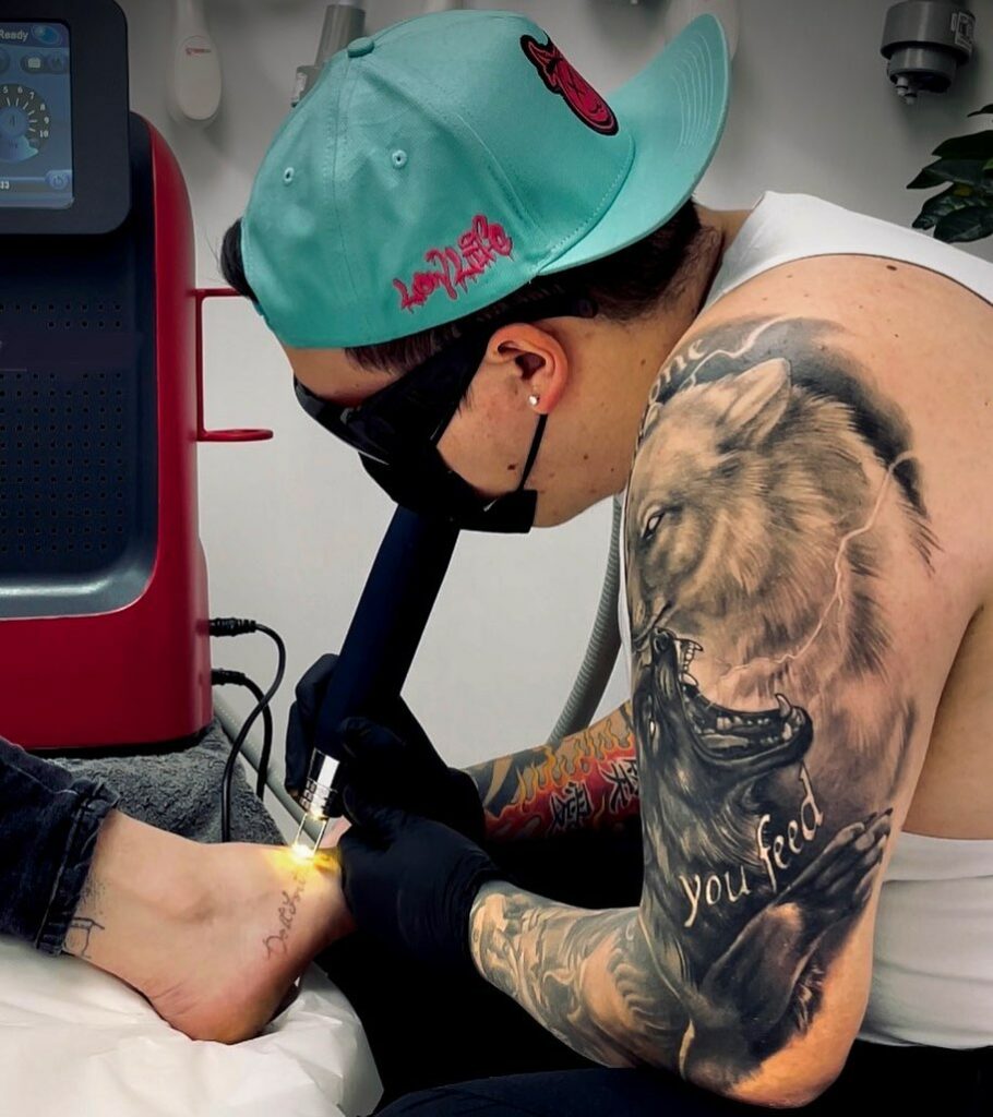 Best Laser Tattoo Removal Machines - Updated For 2024 11 Tattoo Removal
