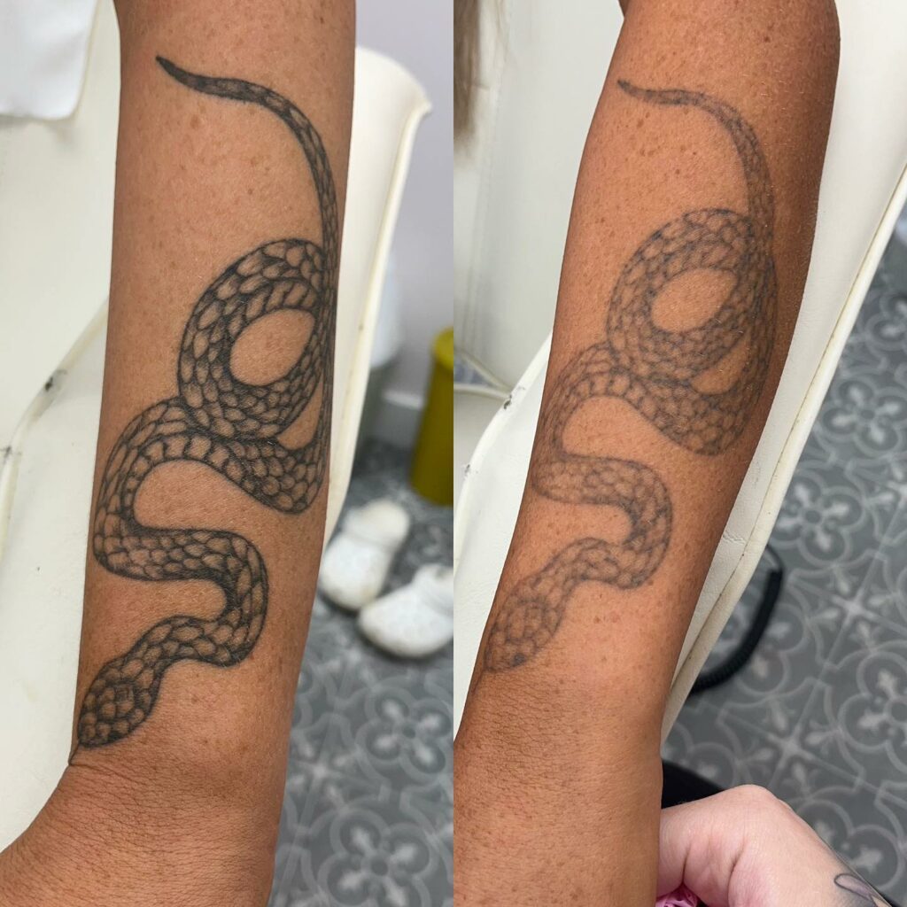 Laser Tattoo Removal Healing Explained Step By Step - Get The Facts In 2024! 14 Tattoo Removal