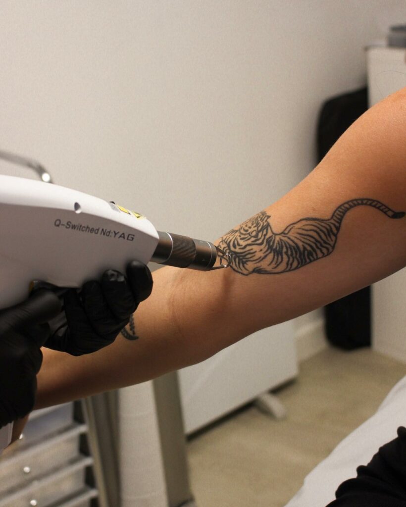 Laser Tattoo Removal Healing Explained Step By Step - Get The Facts In 2024! 13 Tattoo Removal
