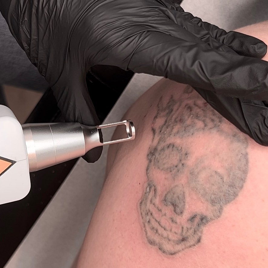 Laser Tattoo Removal Healing Explained Step By Step - Get The Facts In 2024! 12 Tattoo Removal