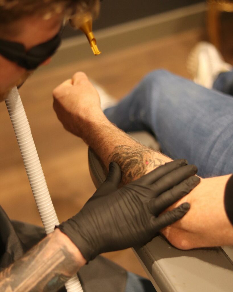 Laser Tattoo Removal vs Saline Tattoo Removal - Everything You Need To Know & More In 2024 13 Tattoo Removal