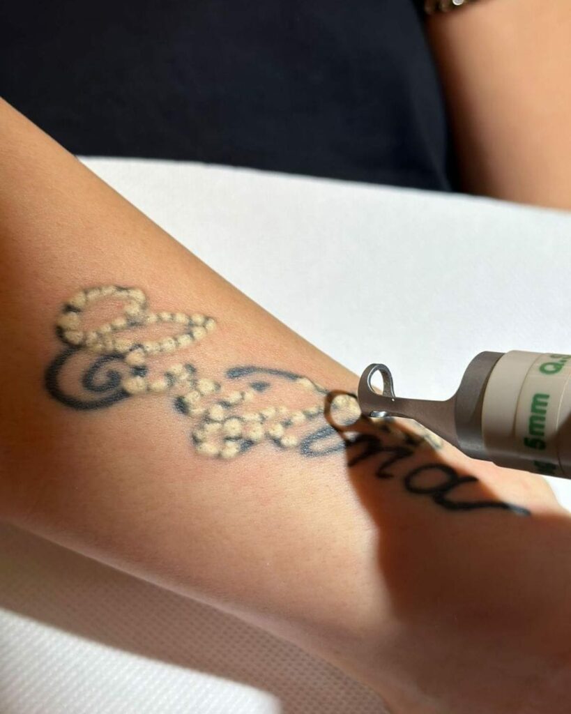 Laser Tattoo Removal vs Saline Tattoo Removal - Everything You Need To Know & More In 2024 12 Tattoo Removal