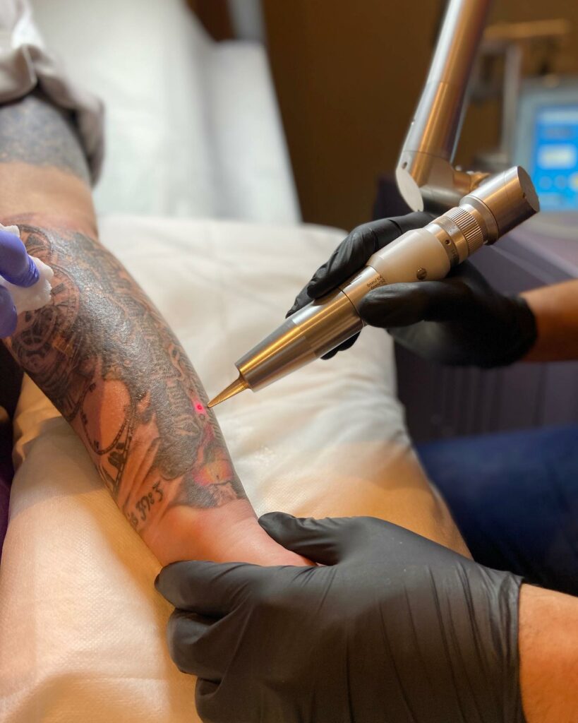 Laser Tattoo Removal vs Saline Tattoo Removal - Everything You Need To Know & More In 2024 10 Tattoo Removal