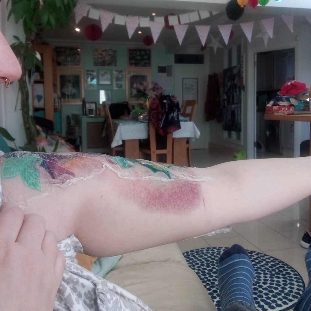 Tattoo Bruising: Causes & Treatment 12 Tattoo Bruise