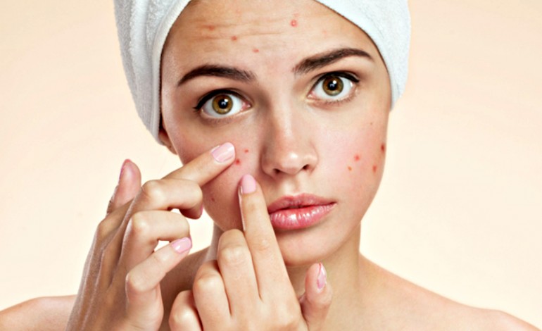 The 15 Best Moisturisers for Acne 15 woman with spots and sore red skin