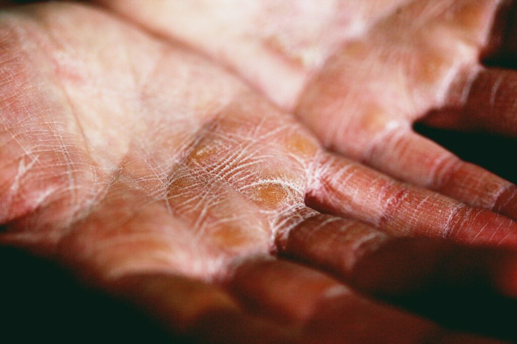 Discover The Incredible Skin Benefits Unleashed by Gotu Kola 14 Soothing Eczema and Psoriasis with Gotu Kola