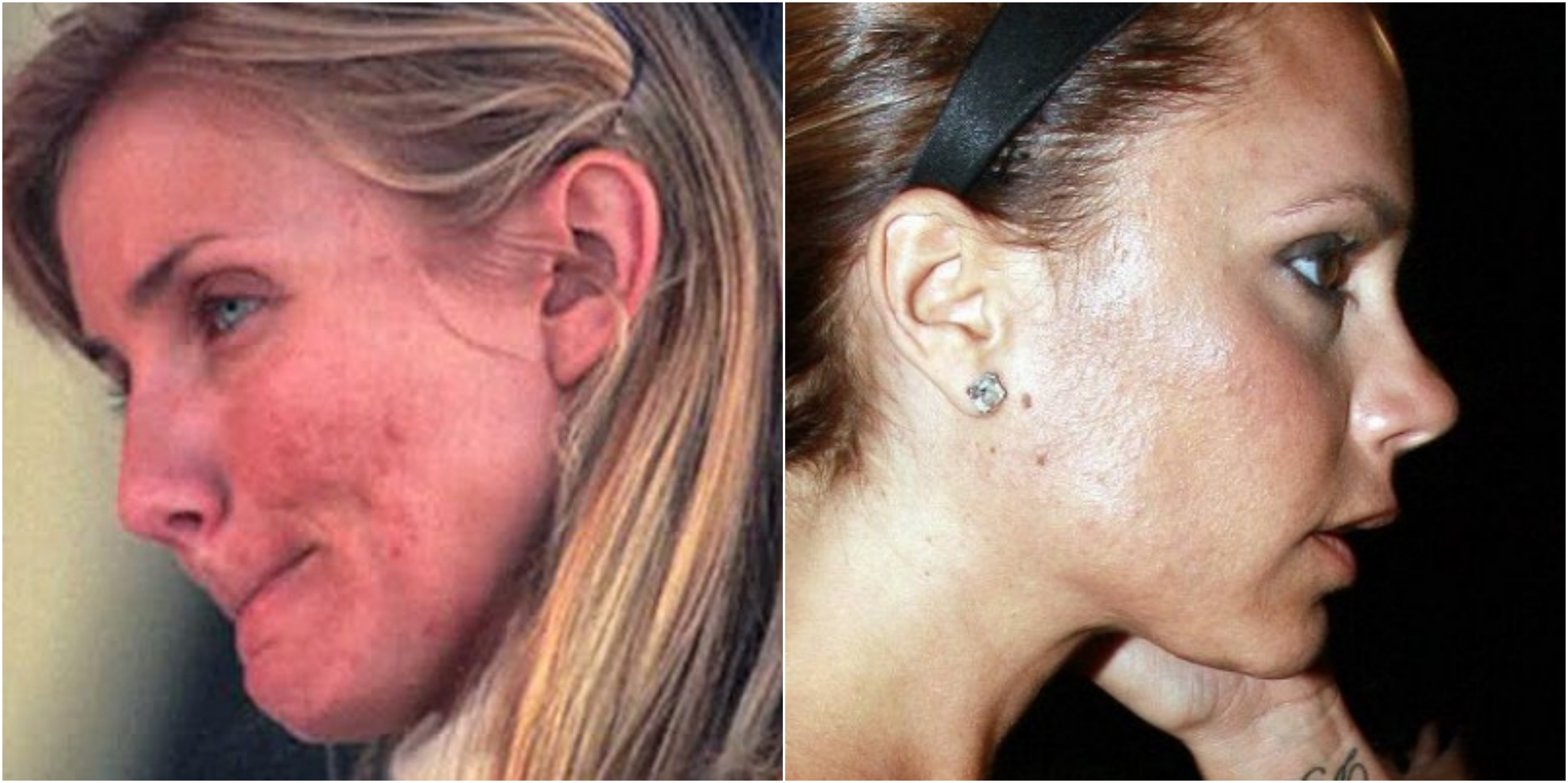 The 15 Best Moisturisers for Acne 22 cameron diaz victoria beckham acne