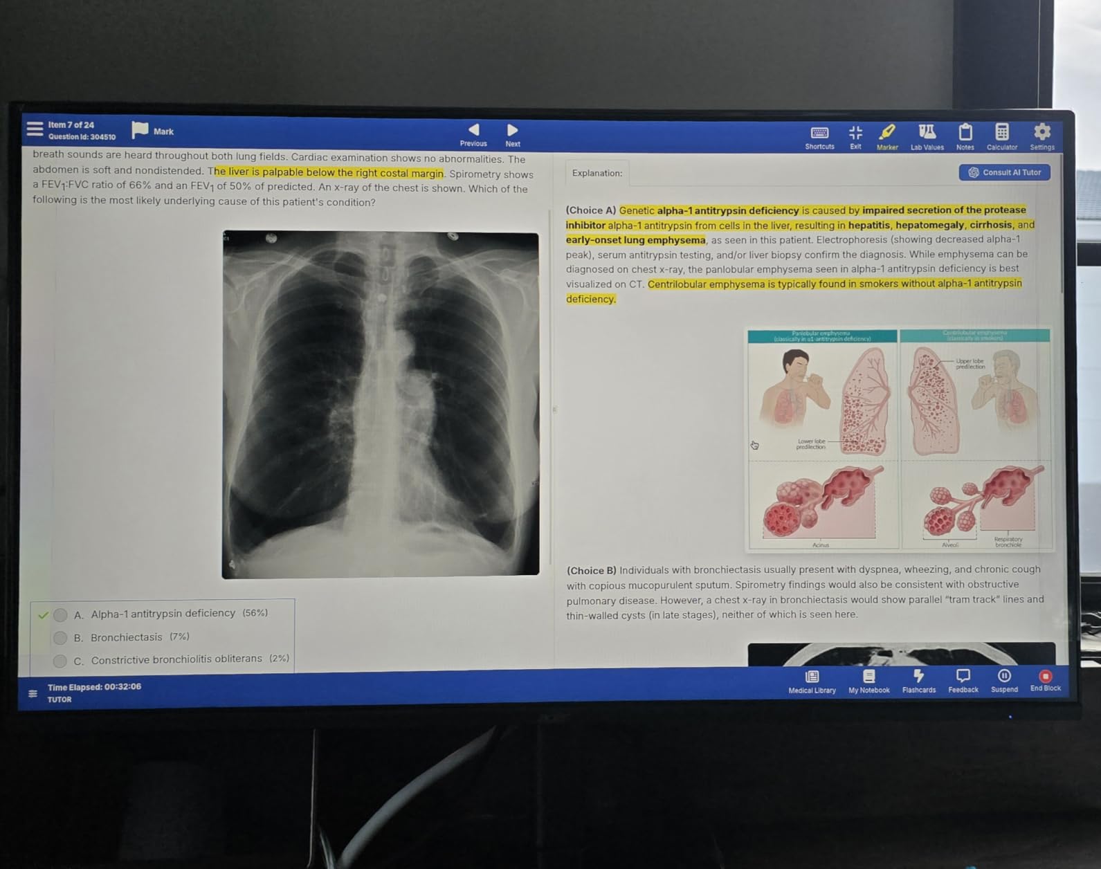 Acer KB242Y - 23.8 Inch IPS Zero-Frame Full HD (1920 x 1080) Monitor | Tilt | Up to 120Hz Refresh | 1ms (VRB) | sRGB 99% | HDMI & VGA Ports | Adaptive-Sync Support (FreeSync Compatible) customer photo 1